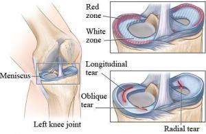 Knee Cartilage Tears