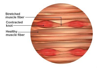 Difference between a healthy muscle fiber, and muscle knot