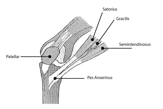 Pes Anserinus Tendinitis