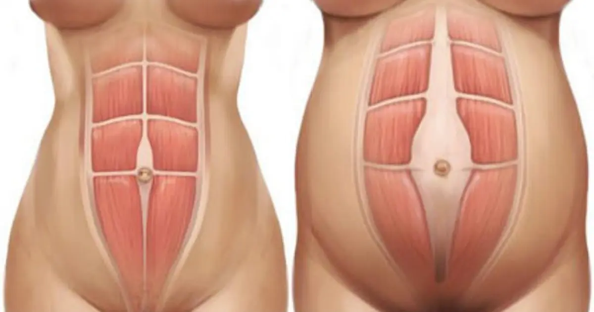 Separation or Stretching of the abdominal muscles (Diastasis Recti Abdominus)
