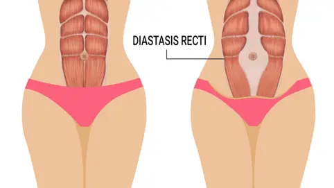 diastasis recti