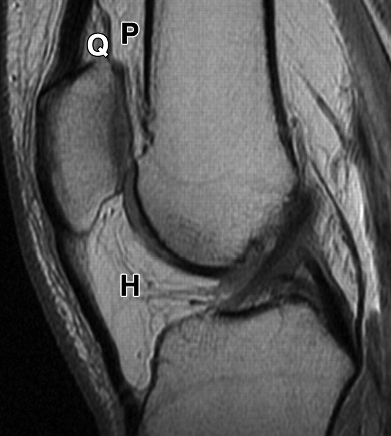 37-year-old man with knee pain and small joint effusion but normal fat pads. Midsagittal intermediate-weighted MR image shows normal quadriceps (Q), prefemoral fat pad (P), and Hoffa’s fat pad (H). Source: American Roentgen Ray Society