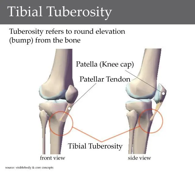 Osgood Schlatter Disease Comprehensive Guide