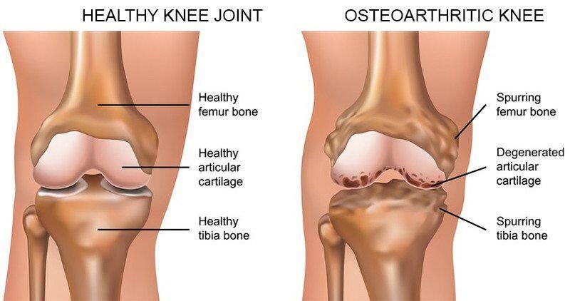 Osteoarthrities Knee Treatment Singapore