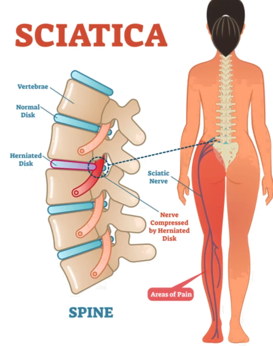 Strengthen your core, ease pain.  Sciatica exercises, Nerve pain, Sciatic  nerve pain