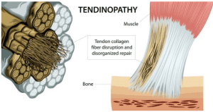 tendinopathy