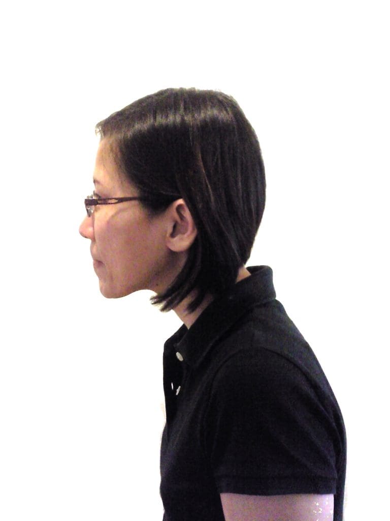 forward head posture